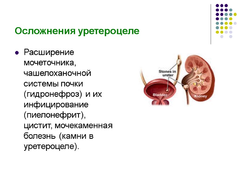Осложнения уретероцеле Расширение мочеточника, чашелоханочной системы почки (гидронефроз) и их инфицирование (пиелонефрит), цистит, мочекаменная